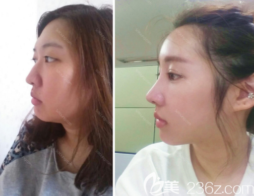 韩国JAYJUN整形外科医院眼鼻真人案例