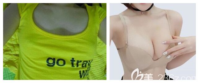 太原时光整形曼托假体隆胸案例