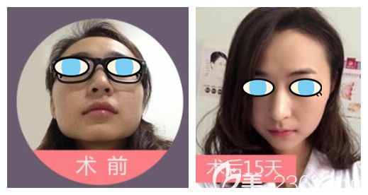 太原时光整形自体脂肪填充案例