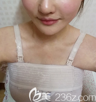 南充韩美自体脂肪隆胸术后即刻 南充韩美自体脂肪隆胸术后即刻