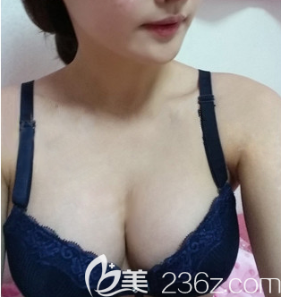 平胸小妹变乳神，全靠南充韩美彭旦生院长给我做的自体脂肪丰胸手术