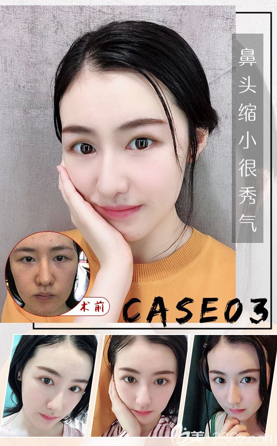 在扬州美贝尔做鼻综合案例 在扬州美贝尔做鼻综合案例