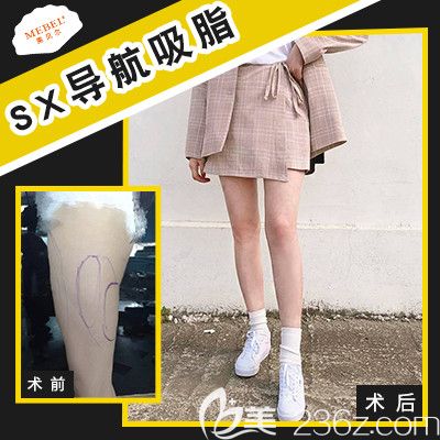 扬州做大腿吸脂推荐美贝尔案例 扬州做大腿吸脂推荐美贝尔案例