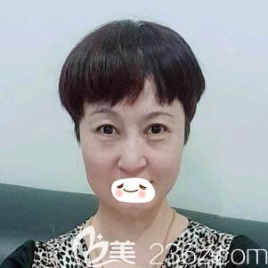 赵彦光医生为我做埋线提升术后2天面部微肿