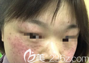 淄博激光祛斑术前照片 淄博激光祛斑术前照片