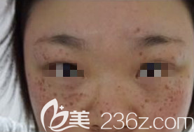 淄博激光祛斑术后即刻照片 淄博激光祛斑术后即刻照片