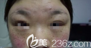 淄博激光祛斑术后第7天 淄博激光祛斑术后第7天