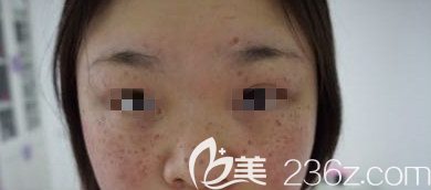 淄博激光祛斑术后第10天 淄博激光祛斑术后第10天