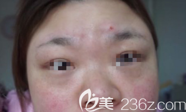 花不到两千在淄博做了激光祛斑手术术后30天来分享照片+心得体会