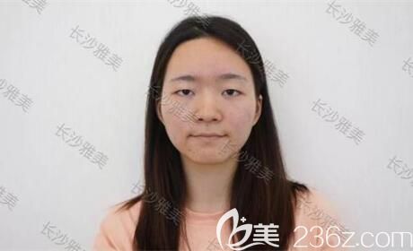 在雅美做眼鼻整形术前照 在雅美做眼鼻整形术前照
