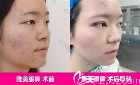 在雅美做眼鼻术前术后即刻效果对比照 在雅美做眼鼻术前术后即刻效果对比照