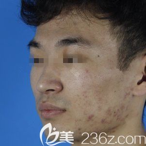 在石家庄天伊美做激光祛痘前满脸痘痘 在石家庄天伊美做激光祛痘前满脸痘痘