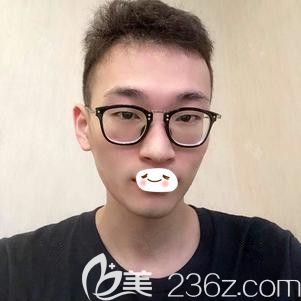 在石家庄天伊美做红蓝光祛痘一周痘痘痘印明显改善 在石家庄天伊美做红蓝光祛痘一周痘痘痘印明显改善