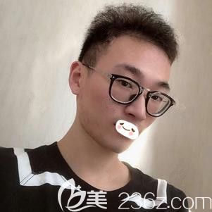 张斌医生为我做红蓝光祛痘术后15天痘痘痘印消失 张斌医生为我做红蓝光祛痘术后15天痘痘痘印消失