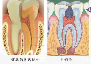 健康牙齿结构和牙髓炎症状对比图
