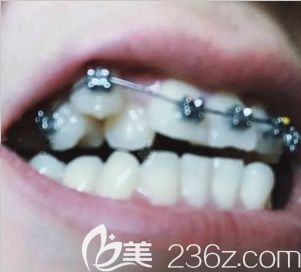 太原众牙口腔正畸一个月时的牙齿照 太原众牙口腔正畸一个月时的牙齿照