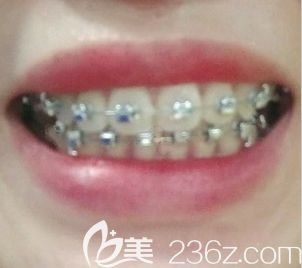 太原众牙口腔正畸一年效果图 太原众牙口腔正畸一年效果图