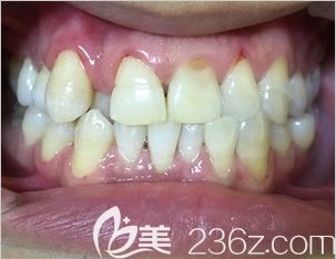 在太原众牙口腔矫正牙齿前的牙齿照 在太原众牙口腔矫正牙齿前的牙齿照