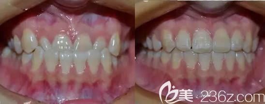 太原众牙口腔牙齿矫正前后效果对比图