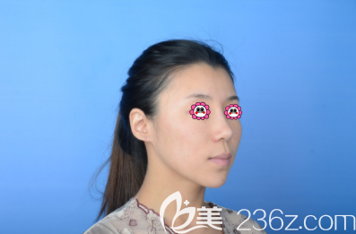 在北京艺美做下巴和泪沟及眉间异物取出修复前样子 在北京艺美做下巴和泪沟及眉间异物取出修复前样子