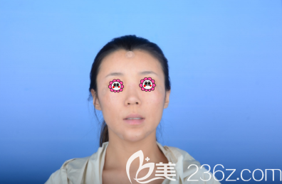 巩敏医生给我做下巴和泪沟及眉间异物取出修复头一日样子 巩敏医生给我做下巴和泪沟及眉间异物取出修复头一日样子