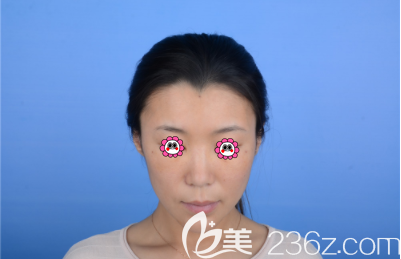 我在北京艺美做下巴和泪沟及眉间异物取出修复第7天样子