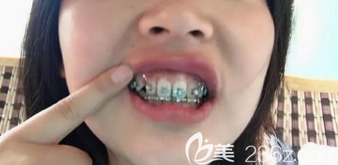 我在深圳弘和口腔做牙齿矫正刚戴牙套 我在深圳弘和口腔做牙齿矫正刚戴牙套