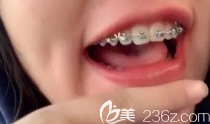 我在深圳弘和口腔做牙齿矫正第5个月 我在深圳弘和口腔做牙齿矫正第5个月