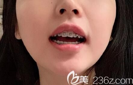 在深圳弘和口腔做金属托槽牙齿矫正第12个月