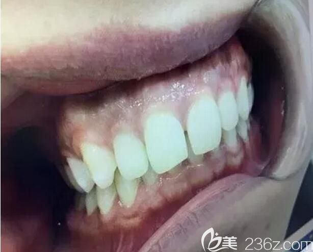 我在深圳弘和口腔做牙齿矫正前的照片 我在深圳弘和口腔做牙齿矫正前的照片