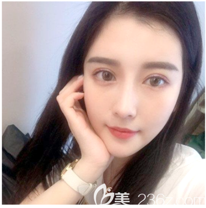 在中信惠州医院整形科做完双眼皮一个月了