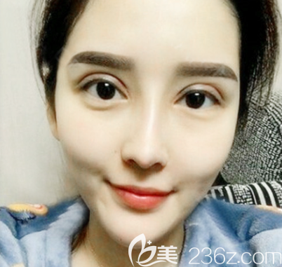 中信惠州医院整形美容科双眼皮8天拆线