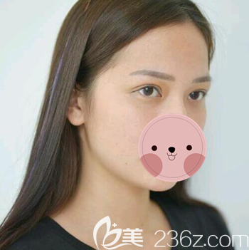 看看宜宾韩美詹清做的双眼皮术后一个月恢复效果图 我觉得自己现在美得不得了