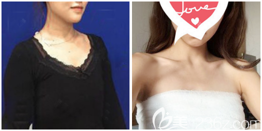 在中信惠州医院整形美容科隆胸术前照片 在中信惠州医院整形美容科隆胸术前照片