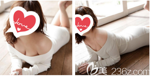 假体隆胸术后一个月恢复效果图 假体隆胸术后一个月恢复效果图