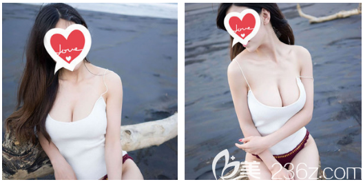 公开我花两万多元找中信惠州医院整形美容科陈虹医生做假体隆胸的亲身经历