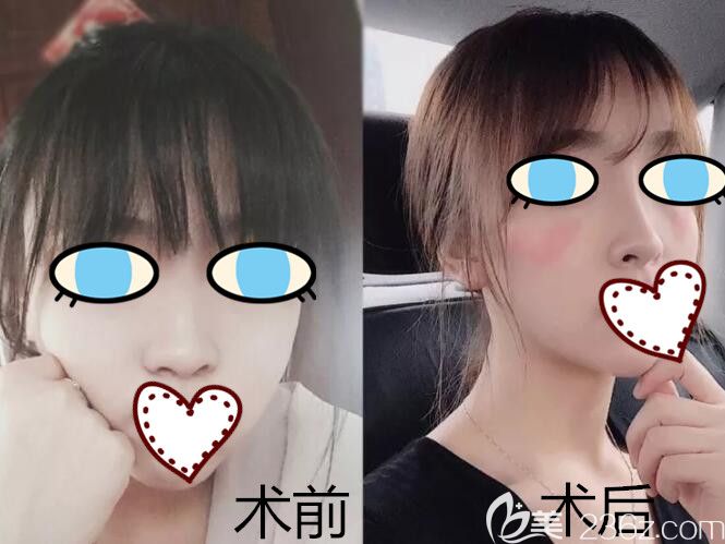 南宁华美整形胡凯假体隆鼻案例