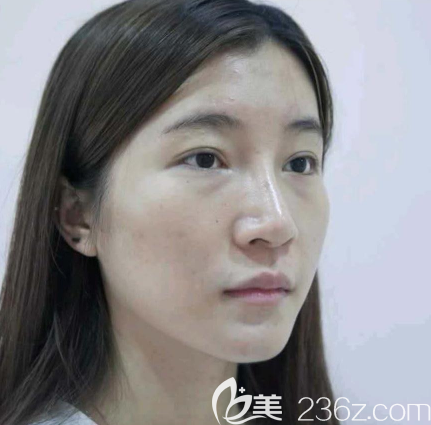 在中信惠州医院整形科做脂肪填充术前照片 在中信惠州医院整形科做脂肪填充术前照片