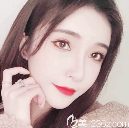 中信惠州医院整形科脂肪填充术后一个月自拍 中信惠州医院整形科脂肪填充术后一个月自拍