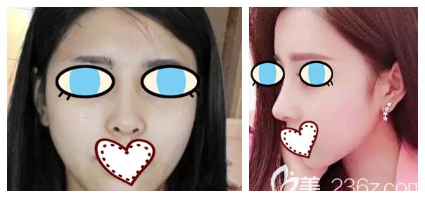 南宁华美胡凯自体肋软骨隆鼻案例