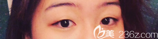 韩国奥纳比整形医院张哲豪自然粘连法双眼皮案例 韩国奥纳比整形医院张哲豪自然粘连法双眼皮案例