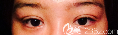 韩国奥纳比张哲豪双眼皮术后一周效果图