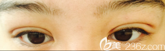 韩国奥纳比双眼皮术后一个月恢复图 韩国奥纳比双眼皮术后一个月恢复图