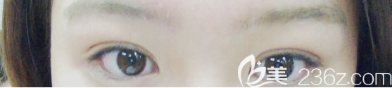 听说张哲豪双眼皮修复技术不错，去韩国奥纳比整形医院做自然粘连法双眼皮术后3个月恢复过程图