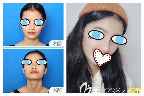  南宁华美整形胡凯鼻综合隆鼻案例