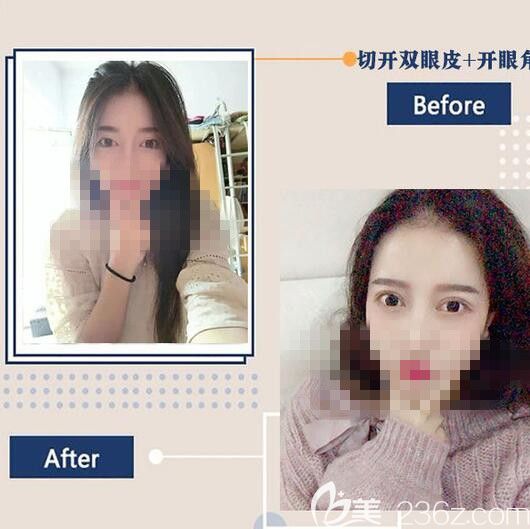 洛阳华美双眼皮整形前后对比
