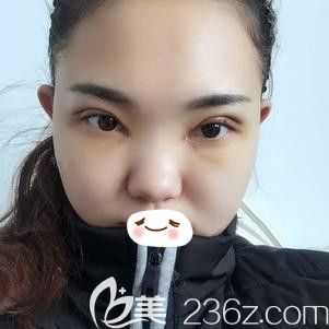 张柏松医生为我做双眼皮术后即刻效果