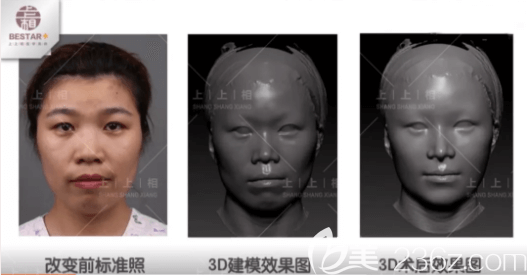 北京上上相医生给我做的改善凸嘴3D模拟效果图