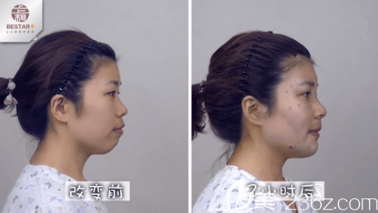 我在北京上上相改善凸嘴前和手术两小时后对比效果