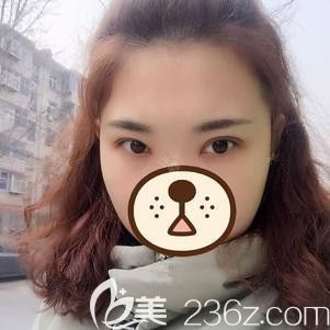 在石家庄天伊美做双眼皮术后一周进行拆线